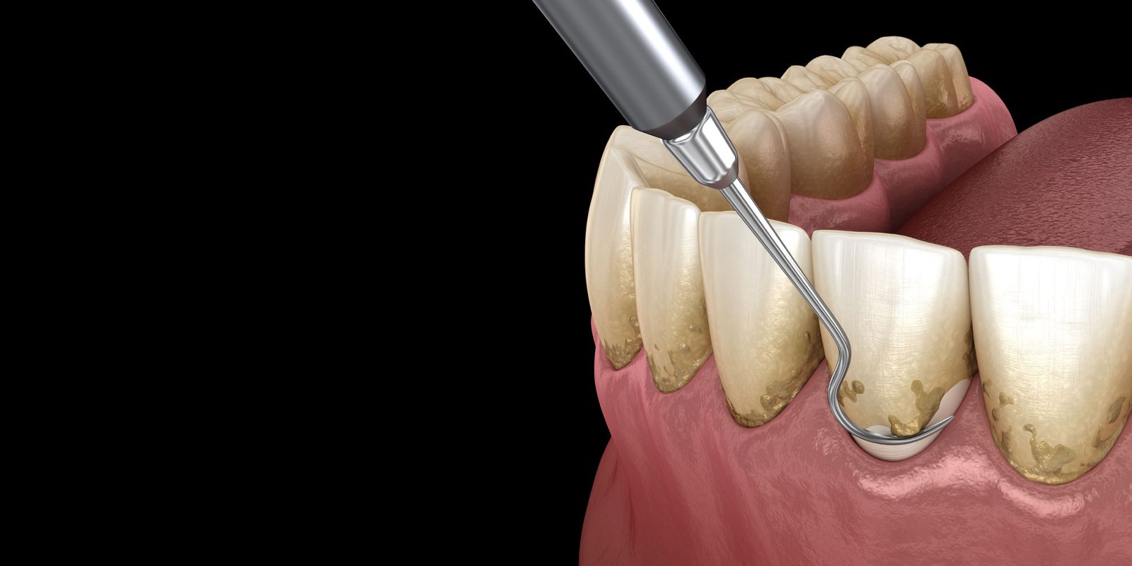 Parodontite cronica? Denti che dondolano? All-on4 Soluzione immediata